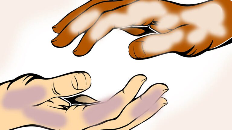 Rüyada Abraş Görmek ve Anlamı